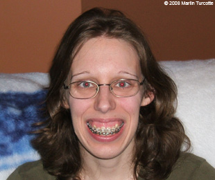 Marie-Hélène Cyr - Before orthognathic surgeries (March 16, 2008)